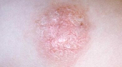 Comment reconnaître le psoriasis à un stade précoce