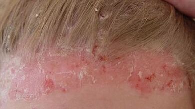 Stades de développement et symptômes du psoriasis.