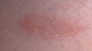 comment et avec quoi traiter le psoriasis