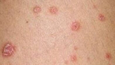 photo du psoriasis au stade initial