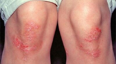 principales manifestations du psoriasis