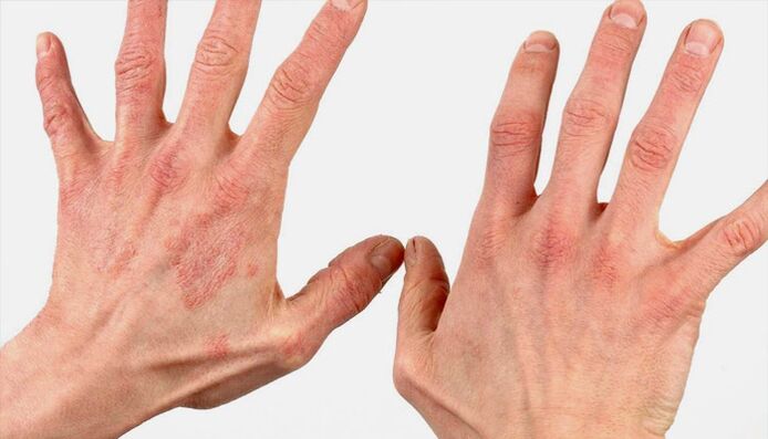 méthodes pour traiter le psoriasis avec des remèdes maison