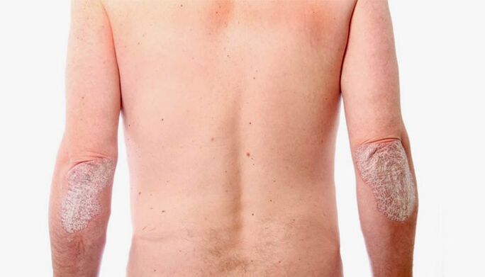 remèdes maison pour le traitement du psoriasis