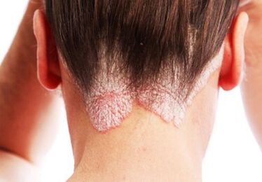 Psoriasis dans la tête