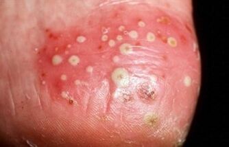 Le psoriasis est pustuleux