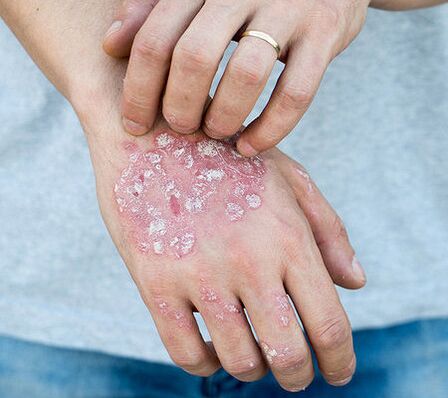 Psoriasis dans le bras