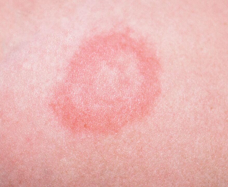 Le psoriasis est