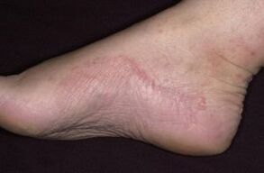 Psoriasis du pied