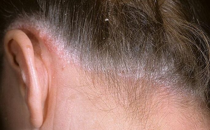 Psoriasis de cheveux