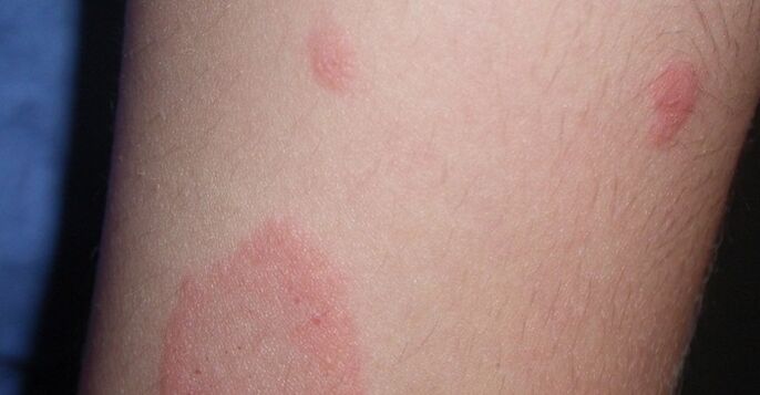 Triasis