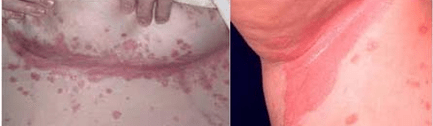 Forme psoriasis atypique