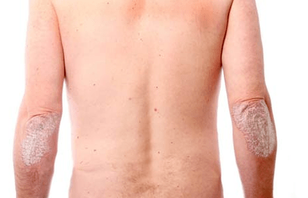 Symptômes généraux du psoriasis