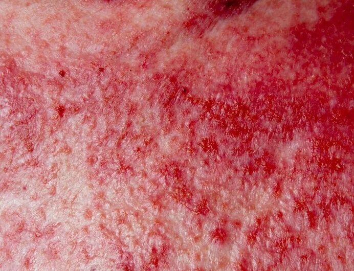 Forme avancée de psoriasis