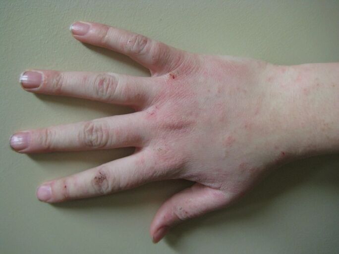Le psoriasis à un stade précoce