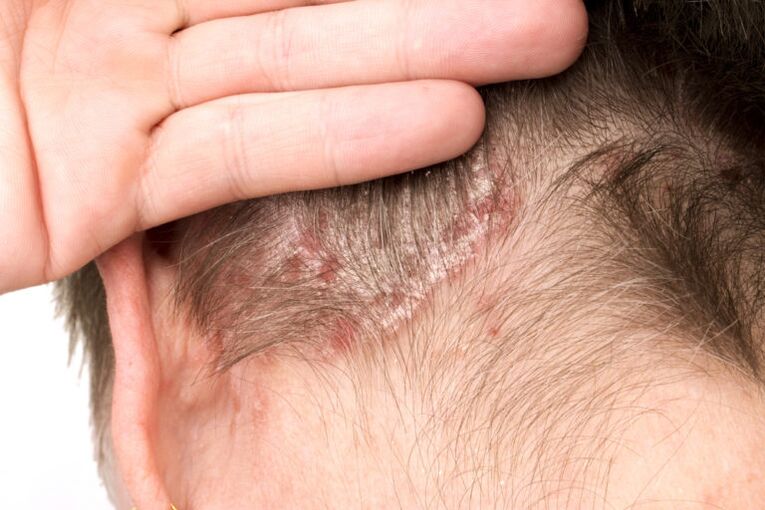 Exacerbation du psoriasis sur la tête.