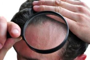 Psoriasis sur la tête à travers une loupe.
