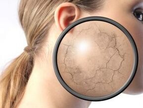 Comment se manifeste le psoriasis 