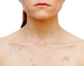 Dans quelles parties du corps apparaît le psoriasis 
