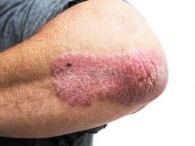 Psoriasis en plaques sur le coude.