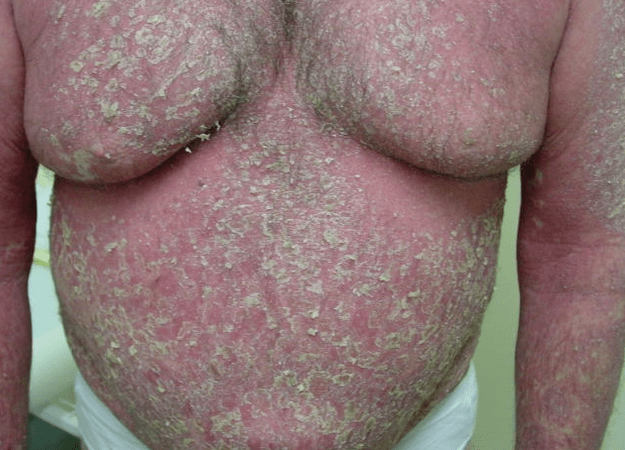 Érythrodermie psoriasique sur le corps.