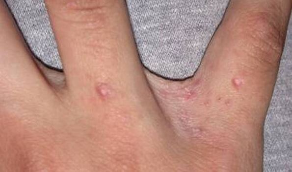 Le début du psoriasis