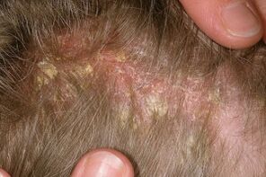 Psoriasis dans la tête