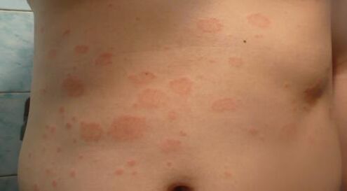 Psoriasis dans le corps