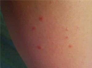 Psoriasis sur la peau