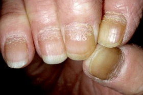 psoriasis des ongles